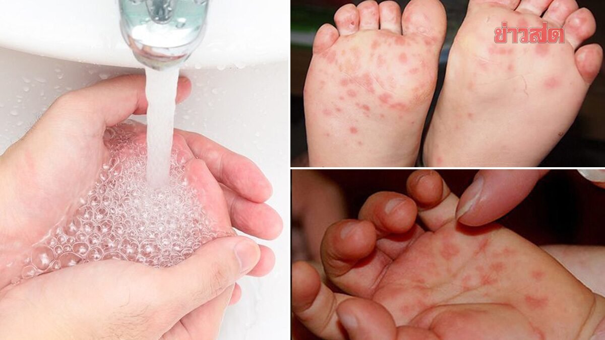มือ เท้า ปาก โรคที่ควรระวังช่วงหน้าฝน มือ เท้า ปาก โรคที่ควรระวังช่วงหน้าฝน