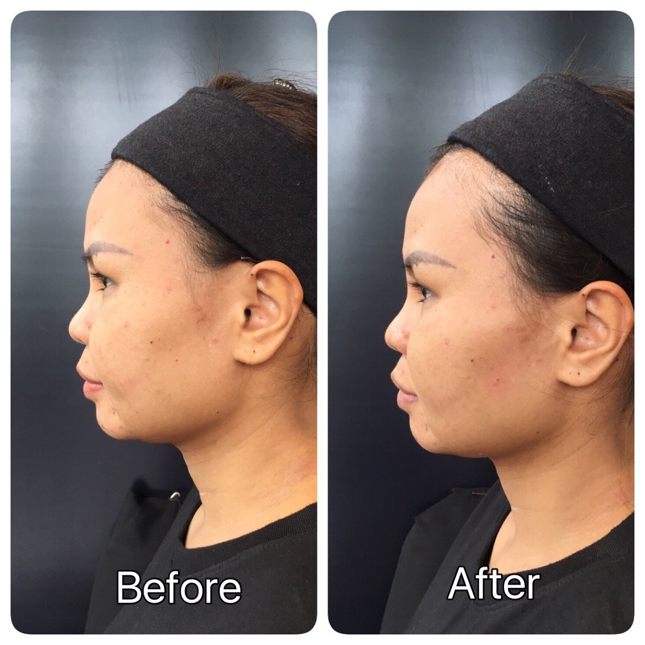 รีวิวก่อนและหลังเข้าโปรแกรมดูแลผิวหน้าและดูแลหนังศรีษะกับ DeMed Clinic