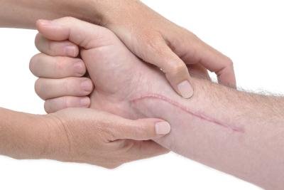 Advanced Keloid Scar Treatment by De Med Clinic