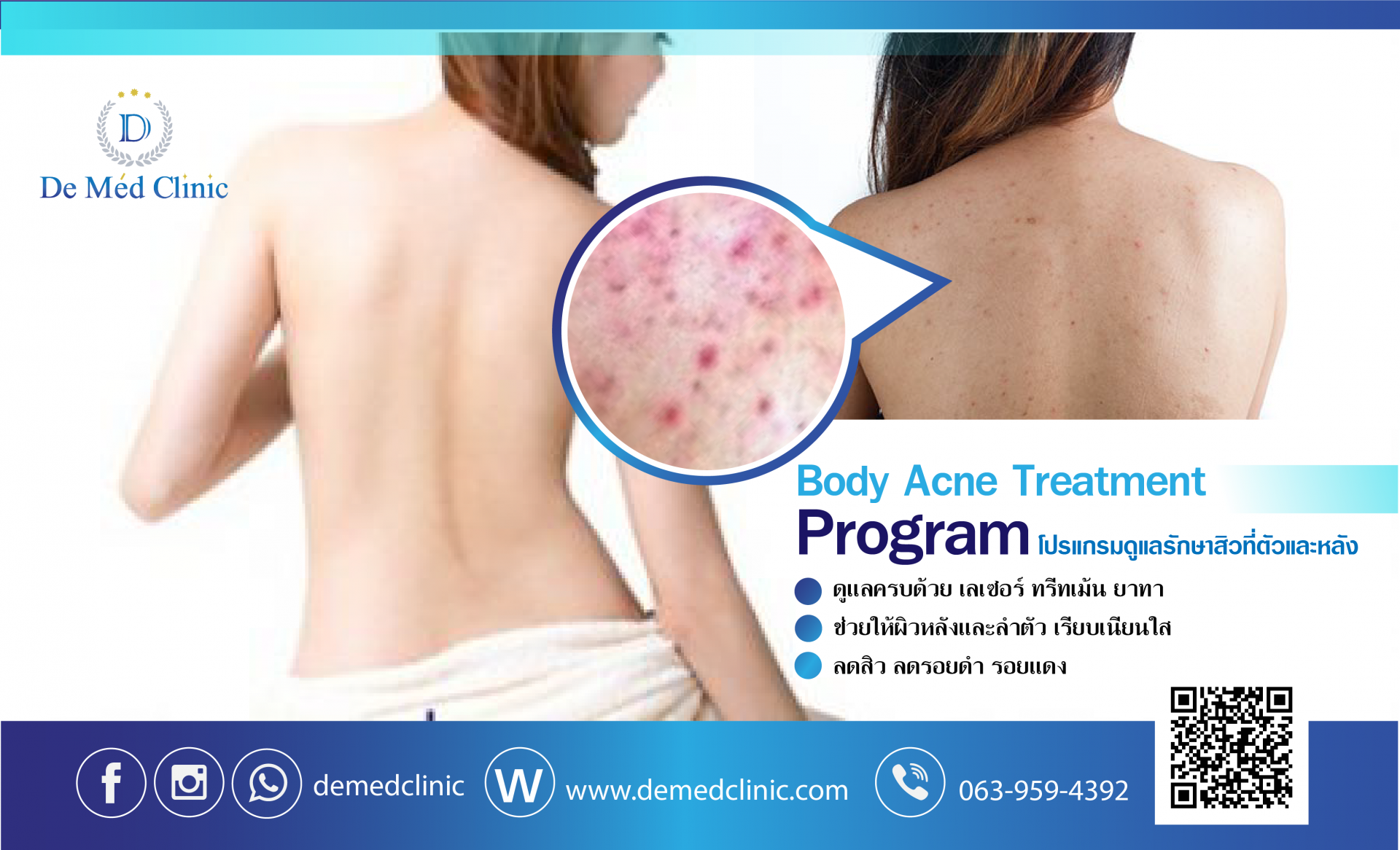 Body Acne Treatment Program by De Med Clinic โปรแกรมดูแลรักษาสิวที่ชำตัวและหลัง