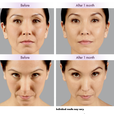 Premium Voluma & Vobella Filler Program by De Med Clinic