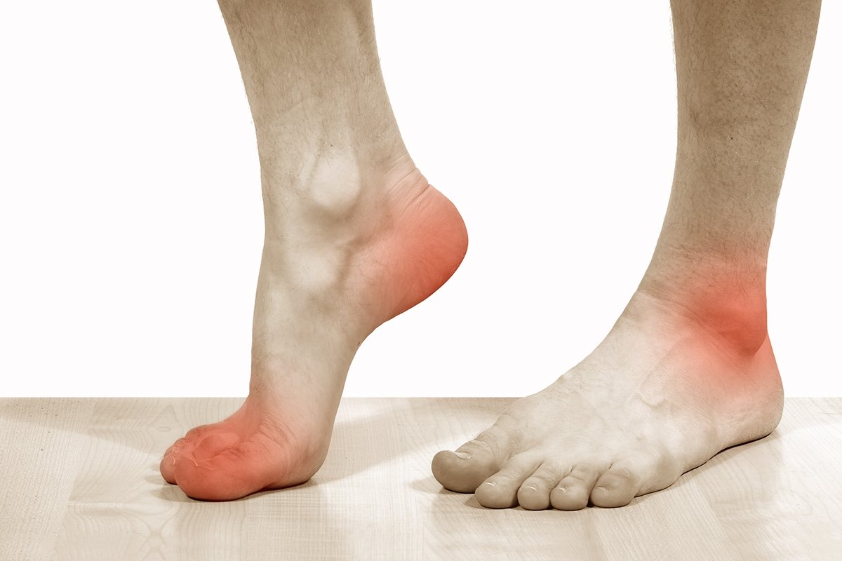 การรักษาตาปลา corn callus