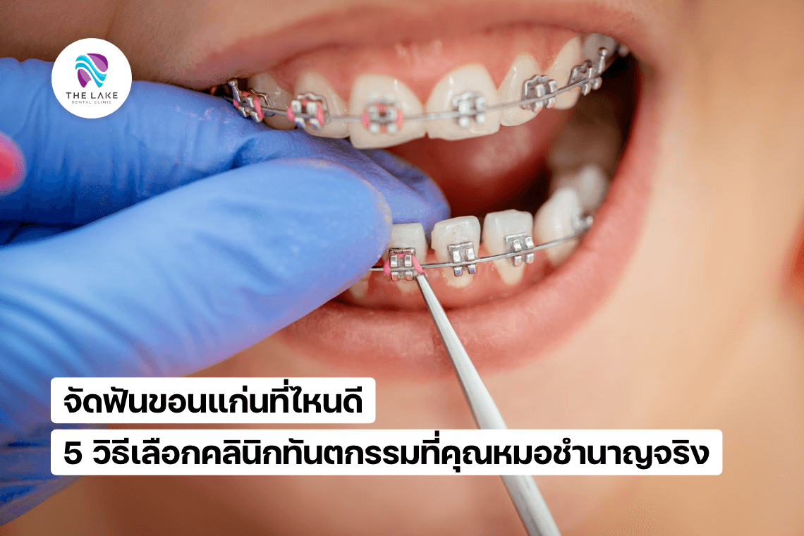 จัดฟันขอนแก่นที่ไหนดีที่คุณหมอชำนาญจริง จัดฟันขอนแก่นที่ไหนดีที่คุณหมอชำนาญจริง