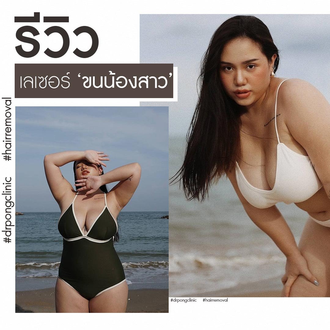 คุณออม - เลเซอร์ขนน้องสาว