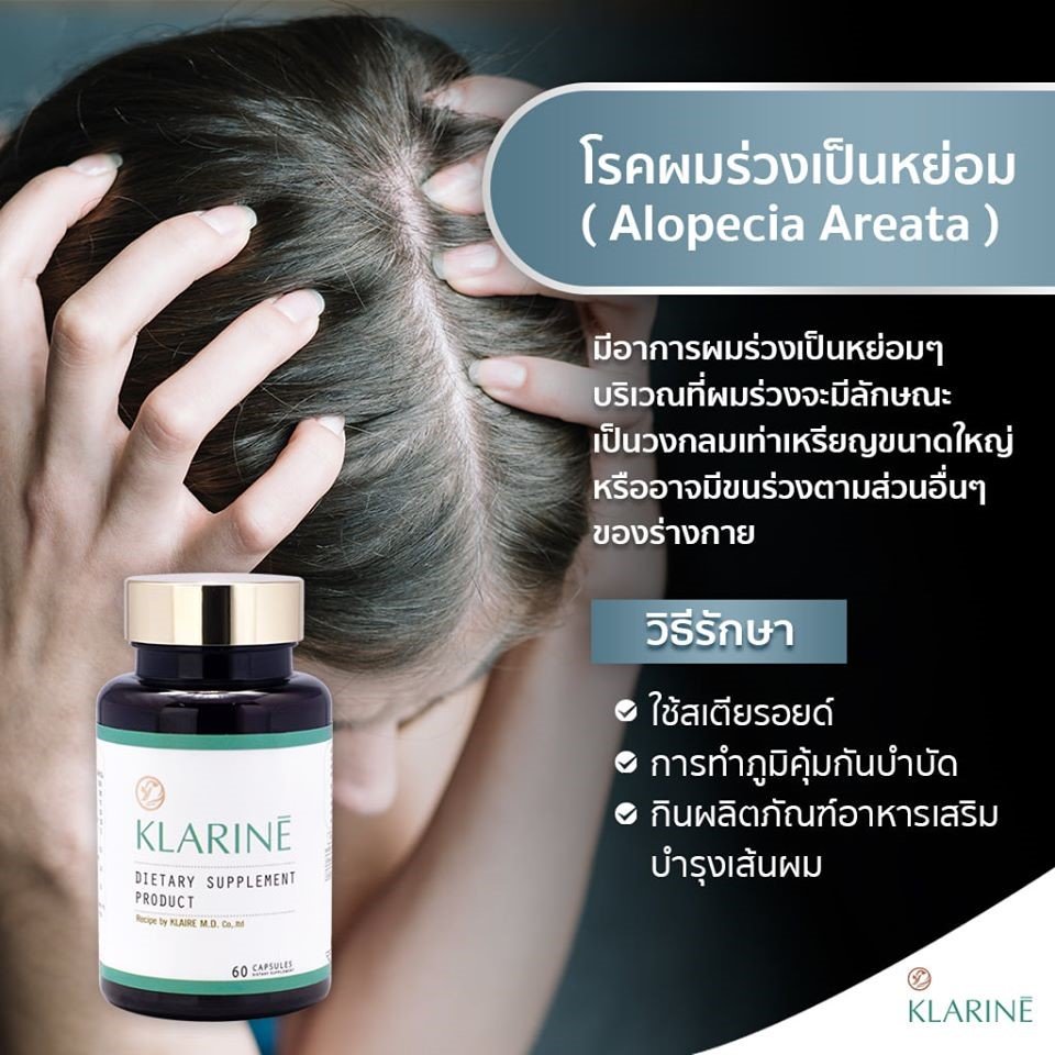 Alopecia Areata makes you feel stress