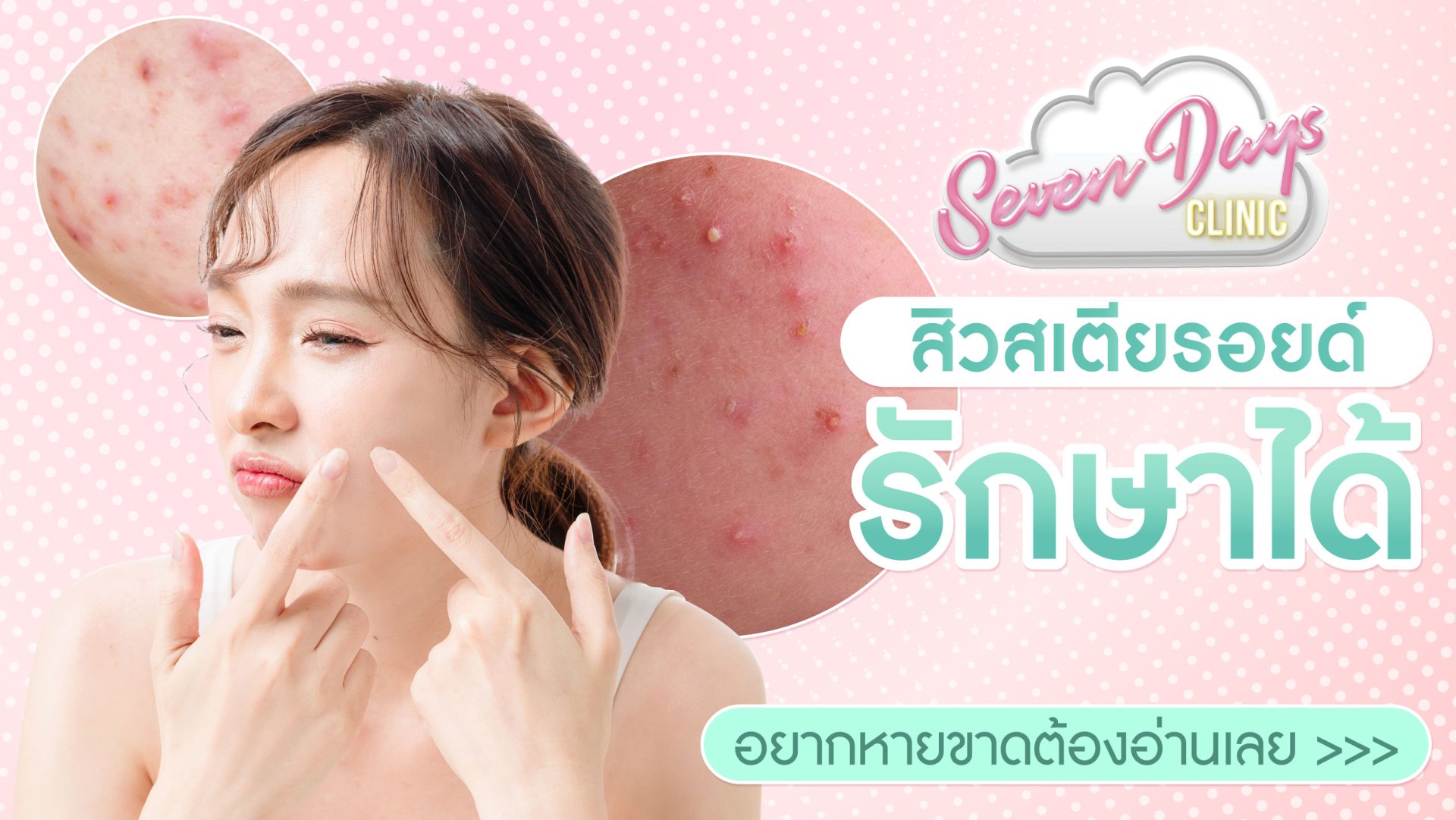 สิวสเตียรอยด์ รักษาได้