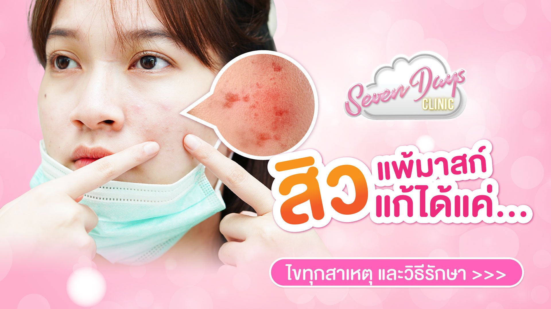 สิวแพ้มาสก์ แก้ได้แค่…