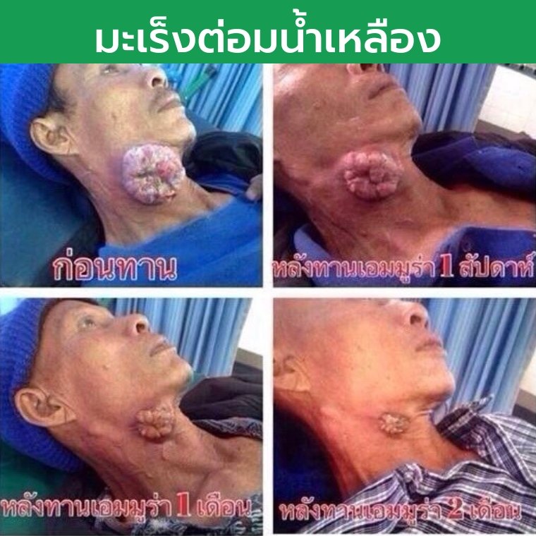 มะเร็งต่อมน้ำเหลือง