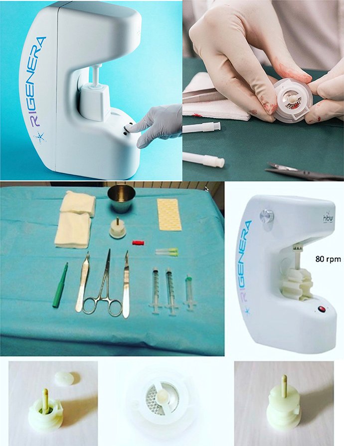 ดูแลผมร่วง ผมบางด้วย Regenera Hair Stem Cell Therapy !! ดูแลผมร่วง ผมบางด้วย Regenera Hair Stem Cell Therapy !!