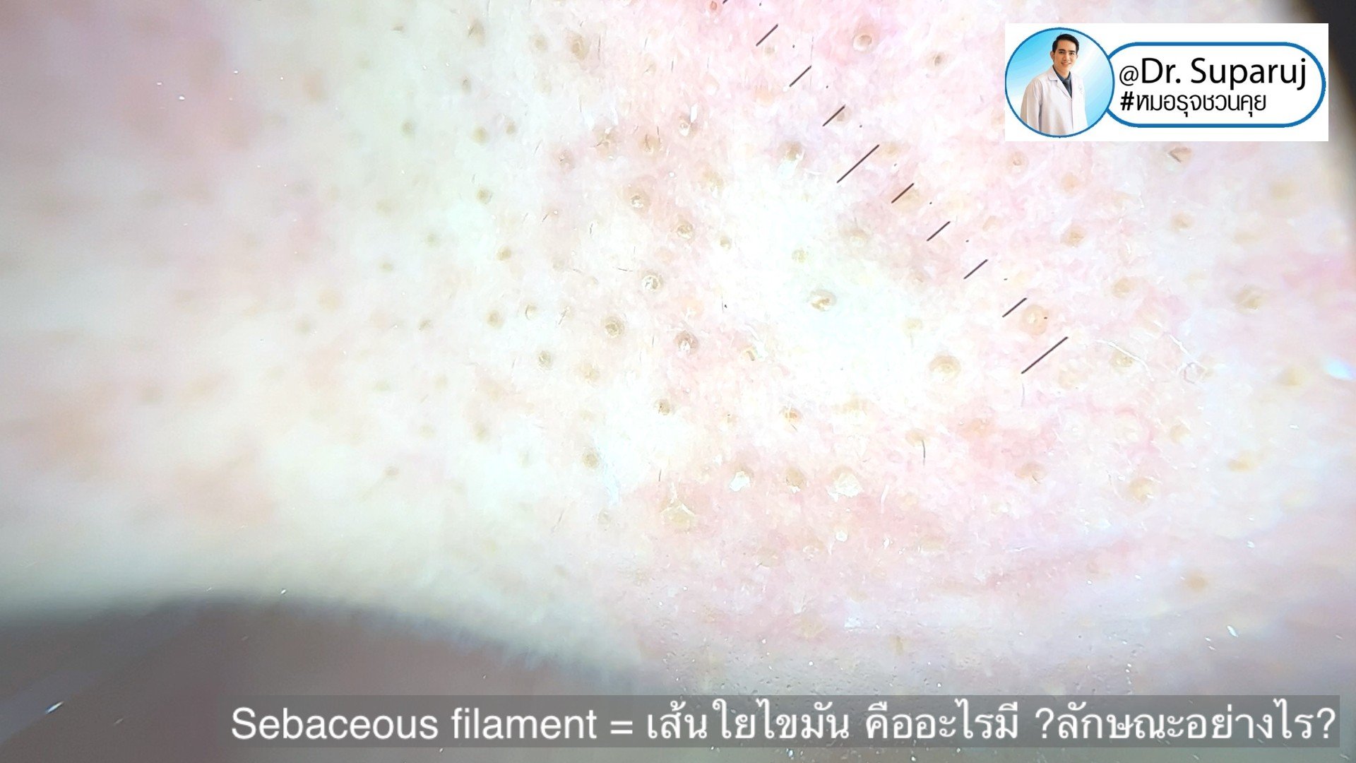 Sebaceous Filaments Face Sebaceous filament = เส้นใยไขมัน คืออะไรมี ?ลักษณะอย่างไร ? ดูแลได้ ...