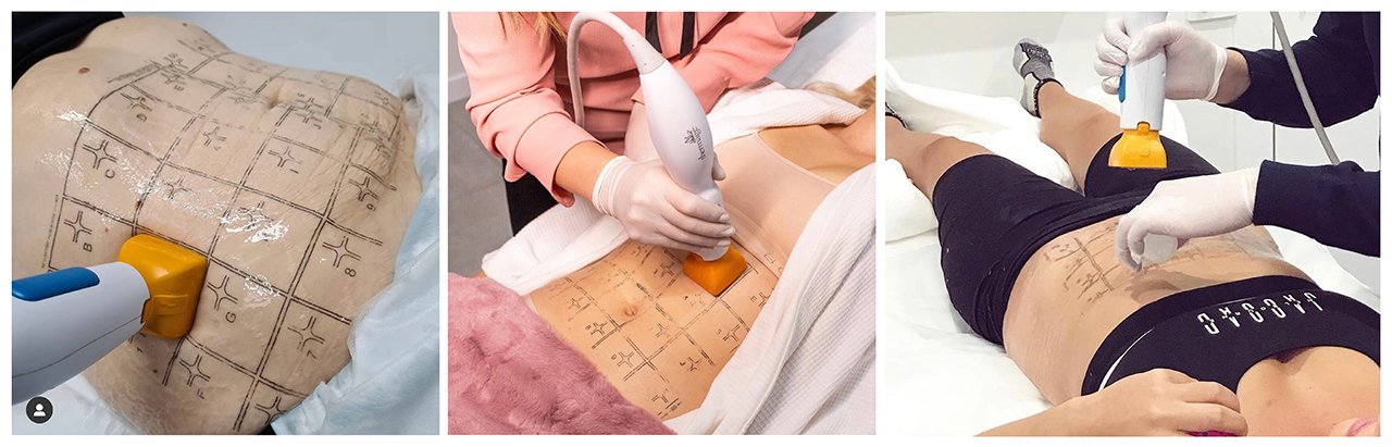 Thermage FLX Body Tip กระชับสัดส่วน (เทอมาจนวัตกรรมใหม่ล่าสุด) Thermage FLX Body Tip กระชับสัดส่วน (เทอมาจนวัตกรรมใหม่ล่าสุด)