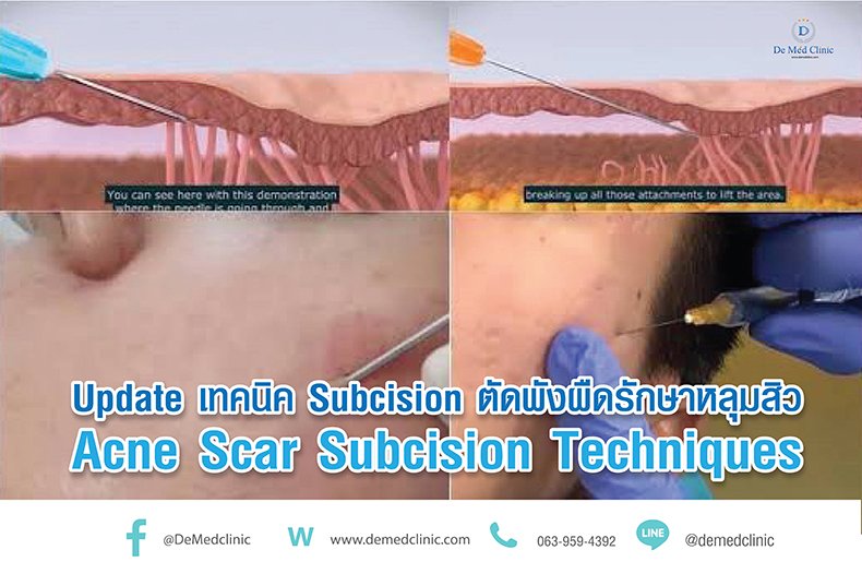 Subcision Thread Update เทคนิค Subcision ตัดพังผืดรักษาหลุมสิว Acne Scar Subcision ...