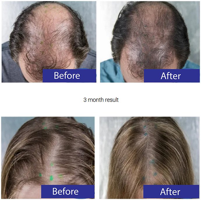 Triple Hair 3H Plus ดูแลผมร่วงผมบาง ครบด้วย เลเซอร์ l สะกิดตัวยา | ผลักวิตามิน | ฉายแสง Triple Hair 3H Plus ดูแลผมร่วงผมบาง ครบด้วย เลเซอร์ l สะกิดตัวยา | ผลักวิตามิน | ฉายแสง