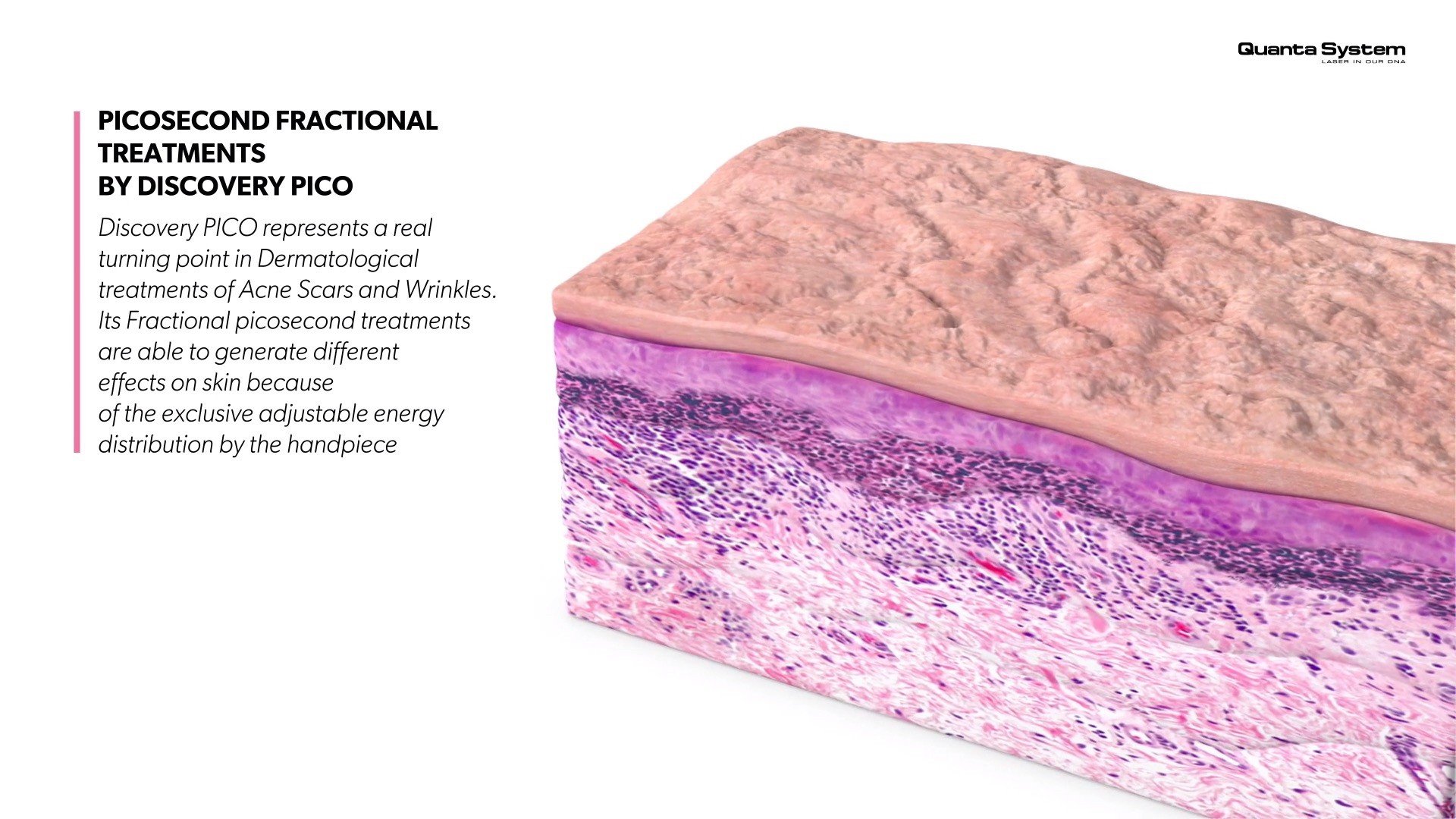 ทำความรู้จัก Discovery Pico Laser เทคนิค จุดเด่นในการดูแลรักษาปัญหาผิวหนัง หลุมสิว รูขุมขนกว้าง กระฝ้า จุดด่างดำ รอยสัก ทำความรู้จัก Discovery Pico Laser เทคนิค จุดเด่นในการดูแลรักษาปัญหาผิวหนัง หลุมสิว รูขุมขนกว้าง กระฝ้า จุดด่างดำ รอยสัก