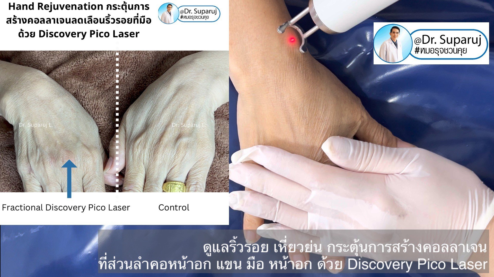 เทคนิคดูแลริ้วรอย เหี่ยวย่น กระตุ้นการสร้างคอลลาเจน ที่ส่วนลำคอหน้าอก แขน มือ หน้าอก ด้วย Discovery Pico Laser เทคนิคดูแลริ้วรอย เหี่ยวย่น กระตุ้นการสร้างคอลลาเจน ที่ส่วนลำคอหน้าอก แขน มือ หน้าอก ด้วย Discovery Pico Laser