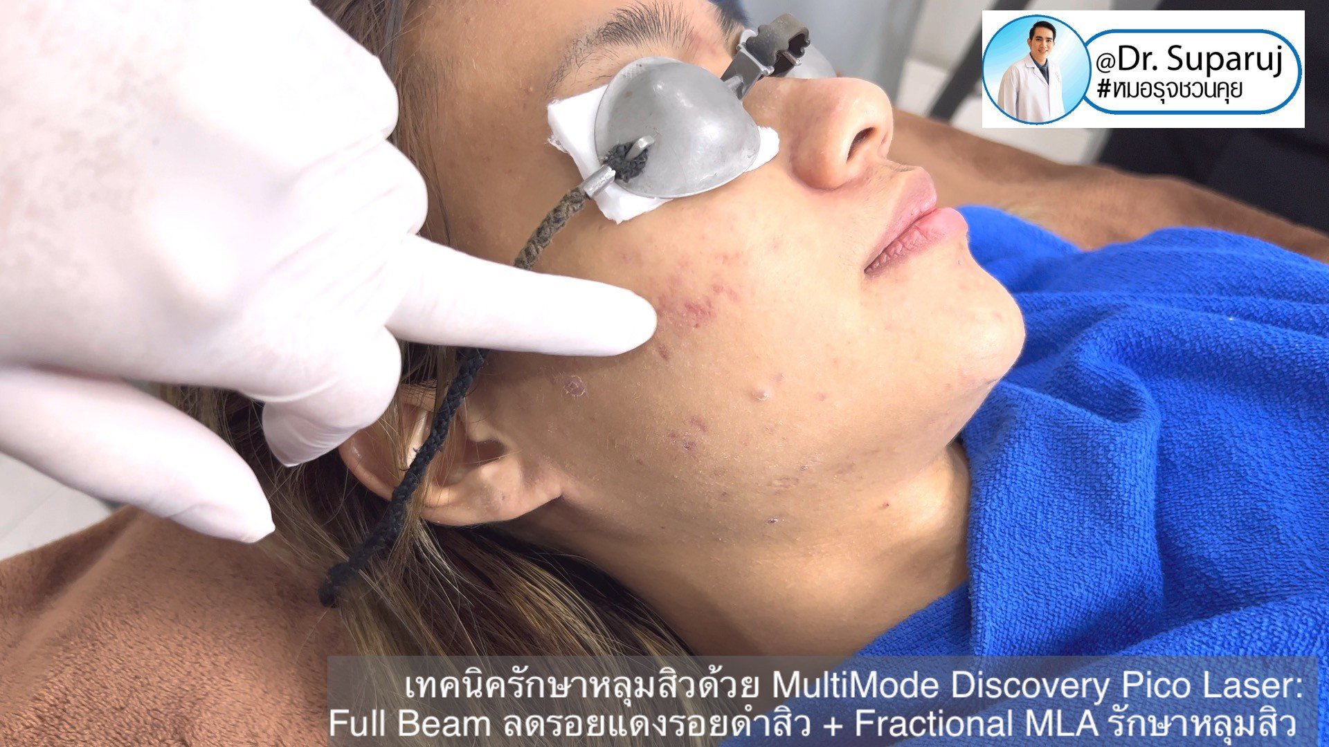 เทคนิครักษาหลุมสิวด้วย MultiMode Discovery Pico Laser: Full Beam ลดรอยแดงรอยดำสิว + Fractional MLA รักษาหลุมสิวครับ เทคนิครักษาหลุมสิวด้วย MultiMode Discovery Pico Laser: Full Beam ลดรอยแดงรอยดำสิว + Fractional MLA รักษาหลุมสิวครับ
