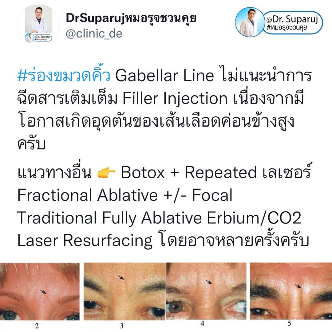 ร่องขมวดคิ้ว Gabellar Line ดูแลได้อย่างไร? ร่องขมวดคิ้ว Gabellar Line ดูแลได้อย่างไร?