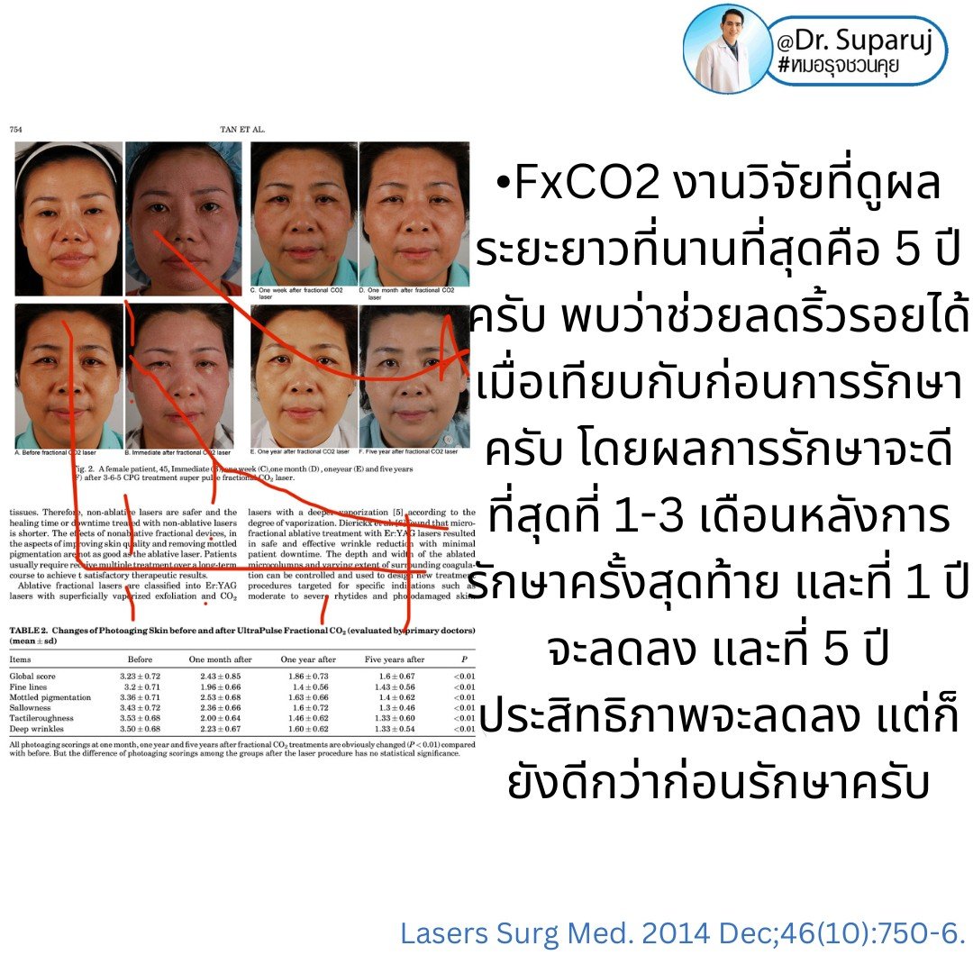 Q: หลังรักษาหลุมสิวด้วยเลเซอร์หรือเทคนิคต่างๆ หลังจากรักษาเรียบร้อยแล้ว จะมีโอกาสกลับมายุบตัว หรือหลุมสิวจะกลับมาแบบเดิมไหม? Q: หลังรักษาหลุมสิวด้วยเลเซอร์หรือเทคนิคต่างๆ หลังจากรักษาเรียบร้อยแล้ว จะมีโอกาสกลับมายุบตัว หรือหลุมสิวจะกลับมาแบบเดิมไหม?