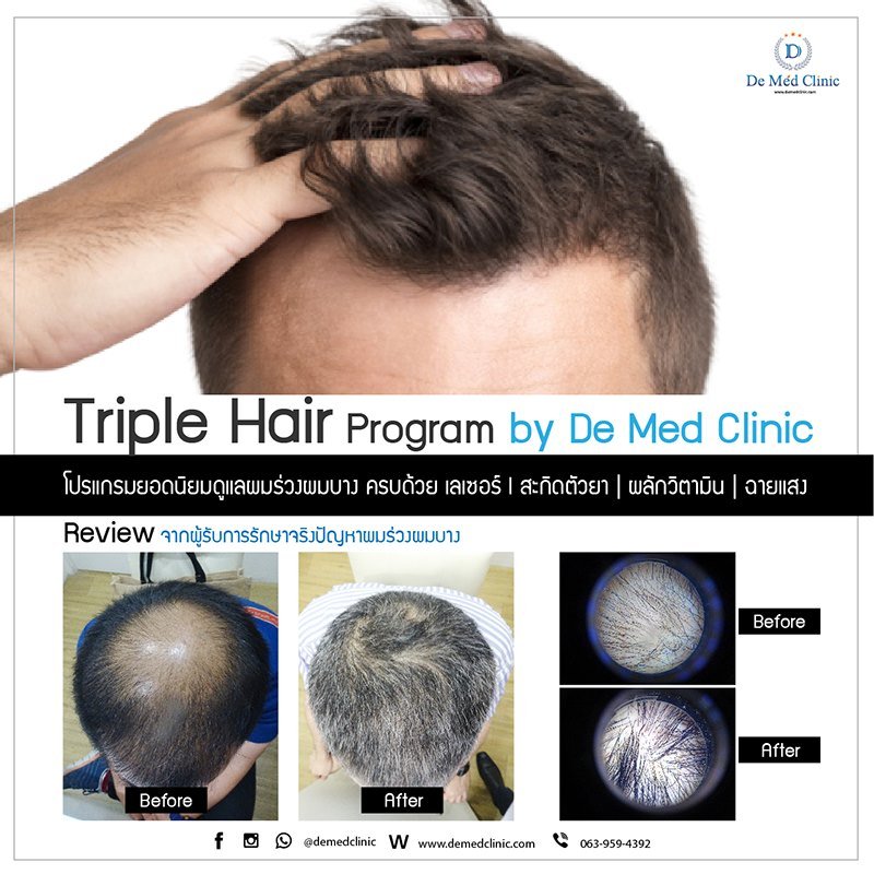 Triple Hair 3H Plus ดูแลผมร่วงผมบาง ครบด้วย เลเซอร์ l สะกิดตัวยา | ผลักวิตามิน | ฉายแสง Triple Hair 3H Plus ดูแลผมร่วงผมบาง ครบด้วย เลเซอร์ l สะกิดตัวยา | ผลักวิตามิน | ฉายแสง