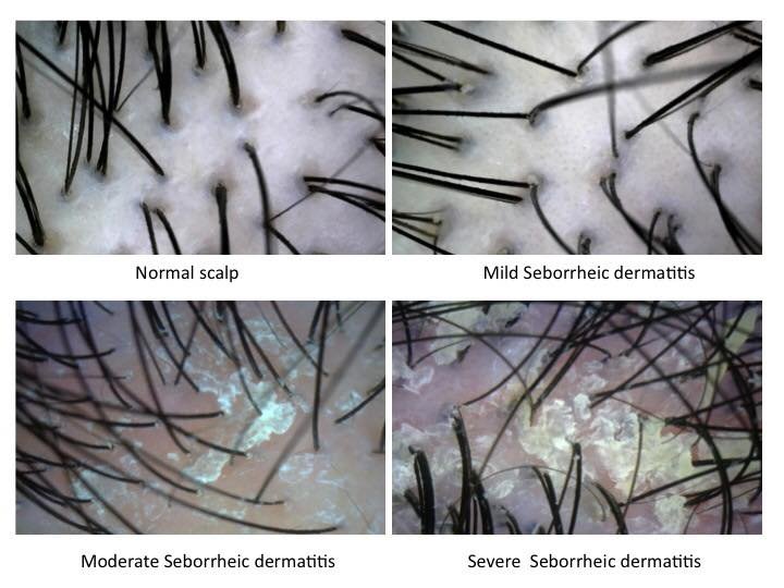 อาการแสดงอาจพบเป็นรังแค โดยมากกว่า 50% ในผู้ใหญ่มักพบปัญหารังแค ขุยแห้งสีเหลืองบริเวณหนังศรีษะ อาการแสดงอาจพบเป็นรังแค โดยมากกว่า 50% ในผู้ใหญ่มักพบปัญหารังแค ขุยแห้งสีเหลืองบริเวณหนังศรีษะ