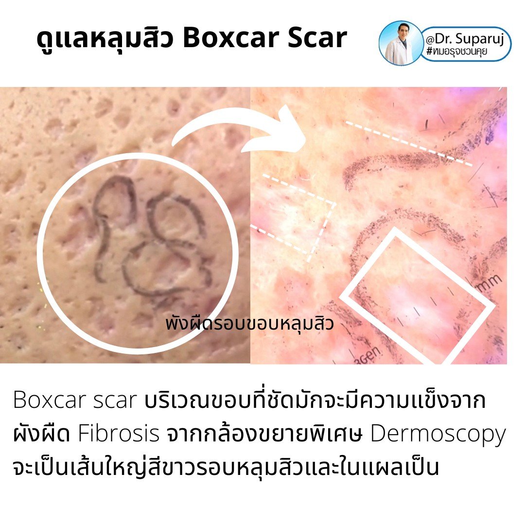 แนะนำเทคนิคดูแลหลุมสิว: เทคนิค Deep Focused Ablative Laser (DFA) ดูแลหลุมสิวลึกขอบชัดพังผืดหนา Boxcar Scar และหลุมสิวลักษณะเส้นยาว Linear scar แนะนำเทคนิคดูแลหลุมสิว: เทคนิค Deep Focused Ablative Laser (DFA) ดูแลหลุมสิวลึกขอบชัดพังผืดหนา Boxcar Scar และหลุมสิวลักษณะเส้นยาว Linear scar