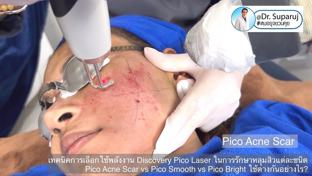 แนะนำเทคนิครักษาหลุมสิว: หัวยิงพิเศษรักษาหลุมสิว Fractional MLA 8 mm. ของ Discovery Pico Laser แนะนำเทคนิครักษาหลุมสิว: หัวยิงพิเศษรักษาหลุมสิว Fractional MLA 8 mm. ของ Discovery Pico Laser