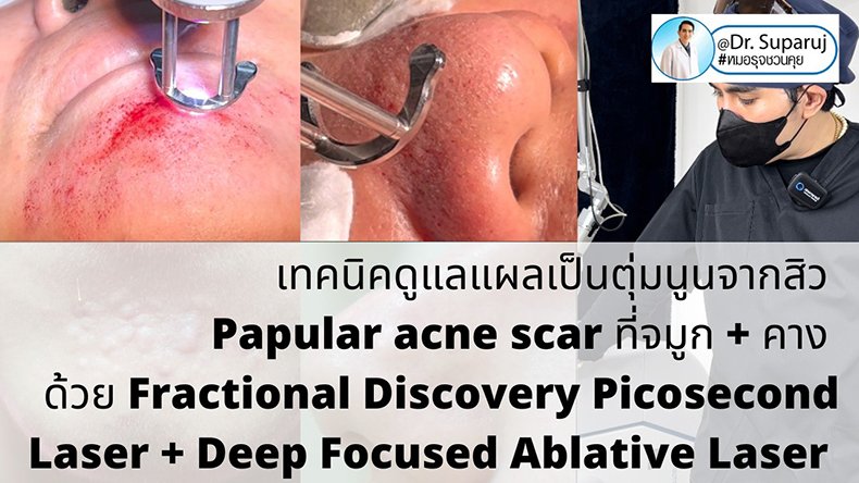 เทคนิคดูแลแผลเป็นตุ่มนูนจากสิว Papular acne scar ที่จมูก + คาง ด้วย Fractional Discovery Picosecond Laser + Deep Focused Ablative Laser