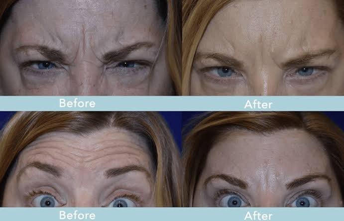 ร่องขมวดคิ้ว Gabellar Line ดูแลได้อย่างไร? ร่องขมวดคิ้ว Gabellar Line ดูแลได้อย่างไร?