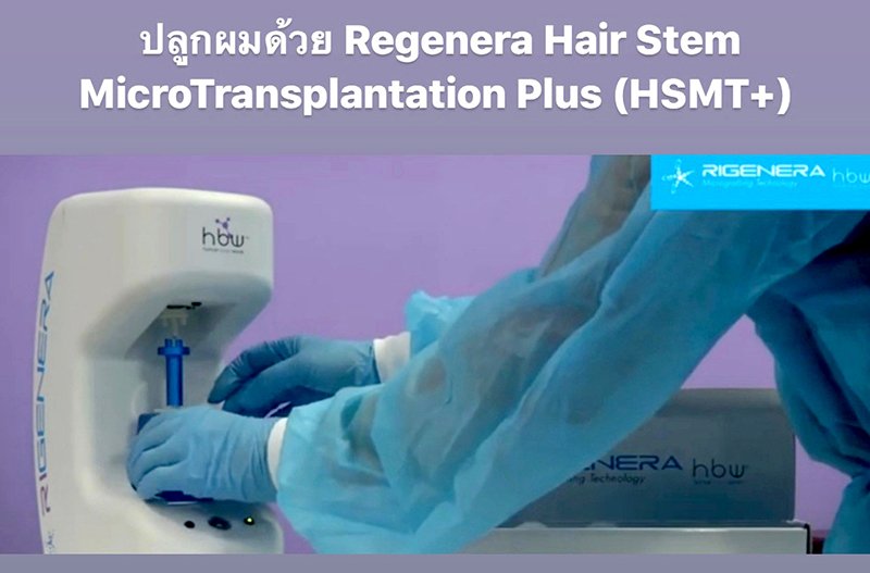 ดูแลผมร่วง ผมบางด้วย Regenera Hair Stem Cell Therapy !! ดูแลผมร่วง ผมบางด้วย Regenera Hair Stem Cell Therapy !!