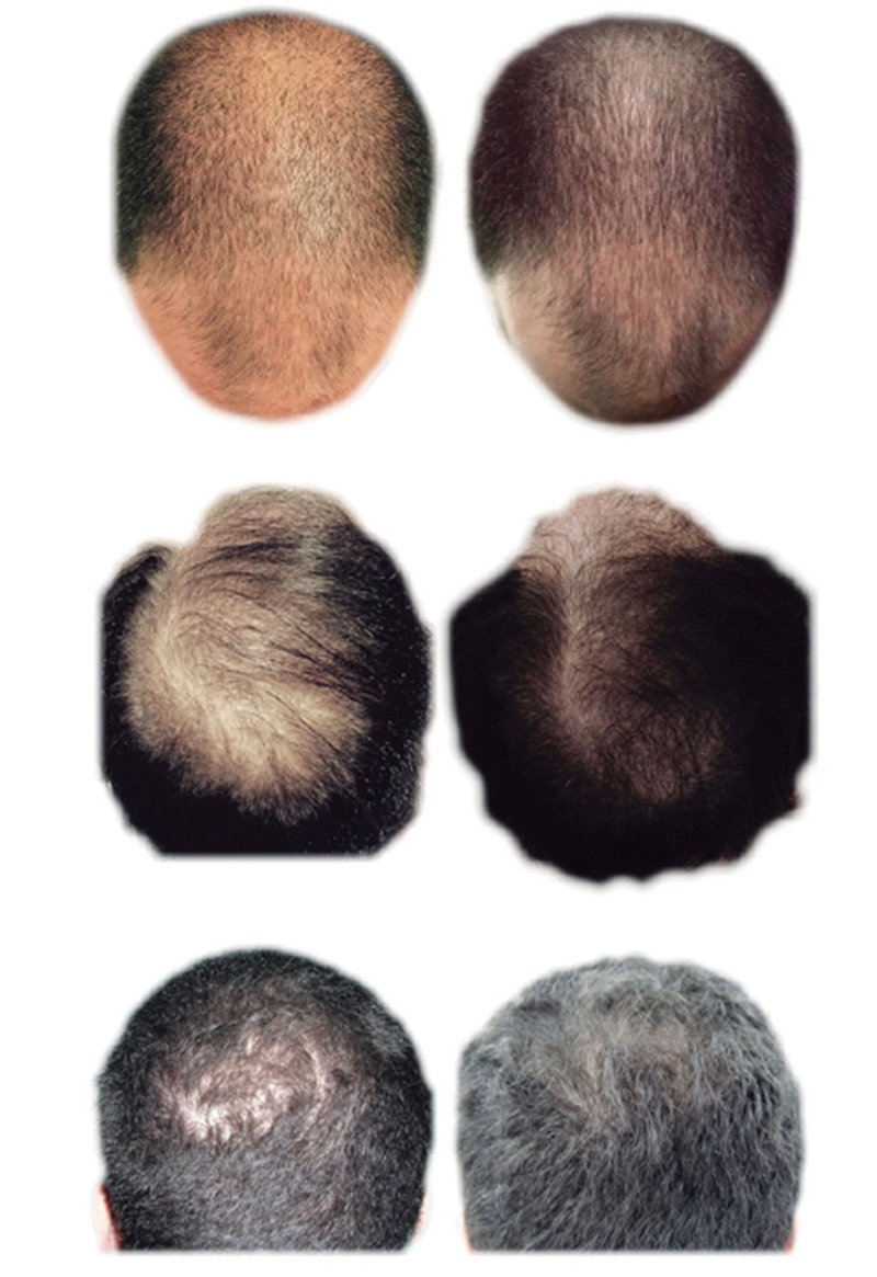 ดูแลผมร่วง ผมบางด้วย Regenera Hair Stem Cell Therapy !! ดูแลผมร่วง ผมบางด้วย Regenera Hair Stem Cell Therapy !!