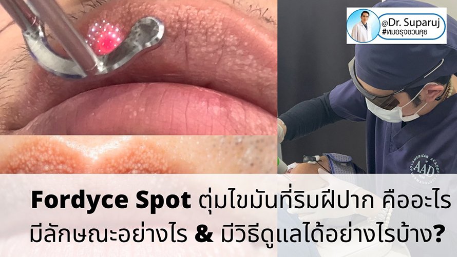  Fordyce Spot ตุ่มไขมันที่ริมฝีปาก คืออะไร มีลักษณะอย่างไร & มีวิธีดูแลได้อย่างไรบ้าง?