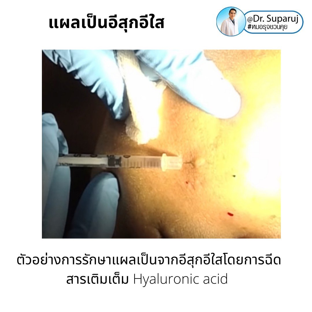 แผลเป็นยุบตัวจากอีสุกอีใส Chicken pox scars ดูแลได้อย่างไร ? แผลเป็นยุบตัวจากอีสุกอีใส Chicken pox scars ดูแลได้อย่างไร ?