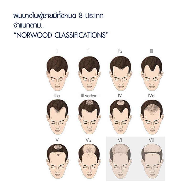 การปลูกผม (Hair Transplantation) คืออะไร