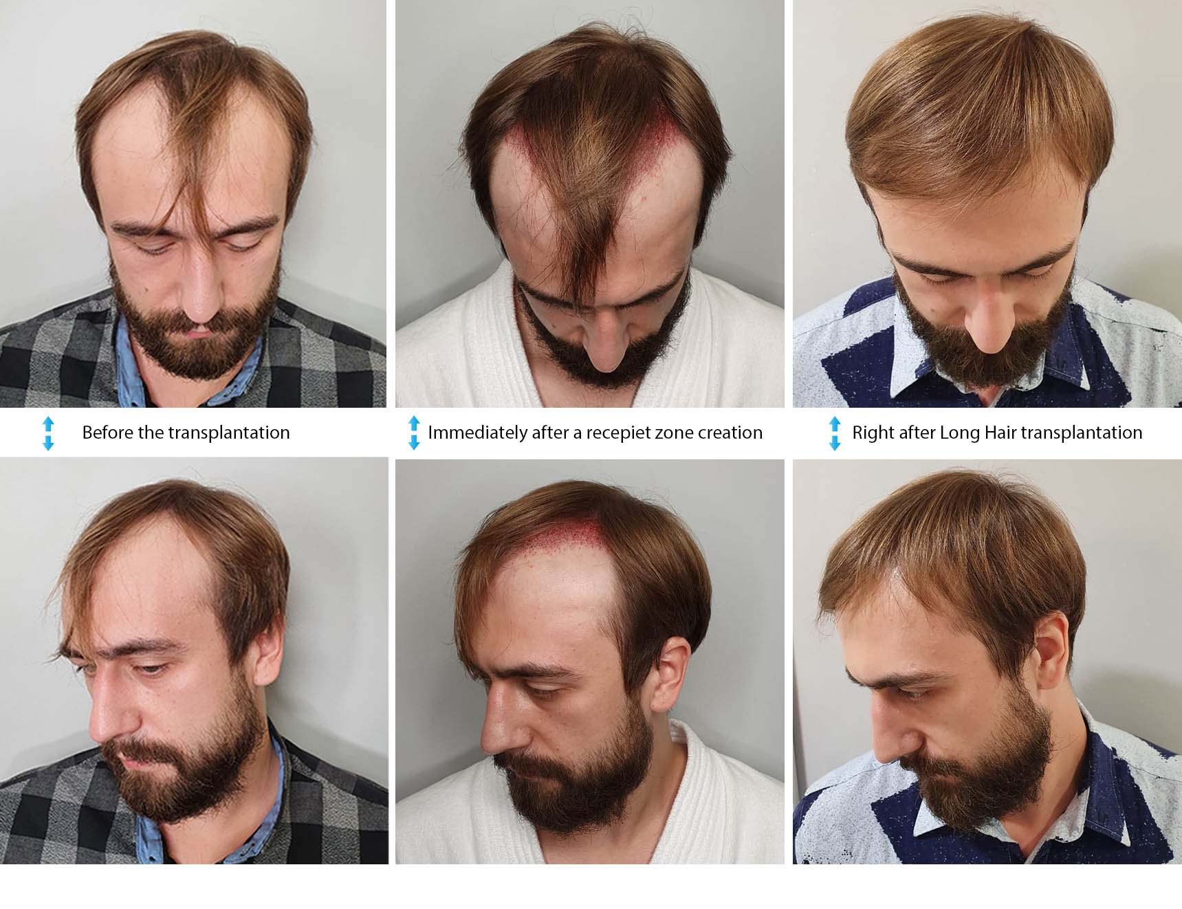 การปลูกผม (Hair Transplantation) คืออะไร