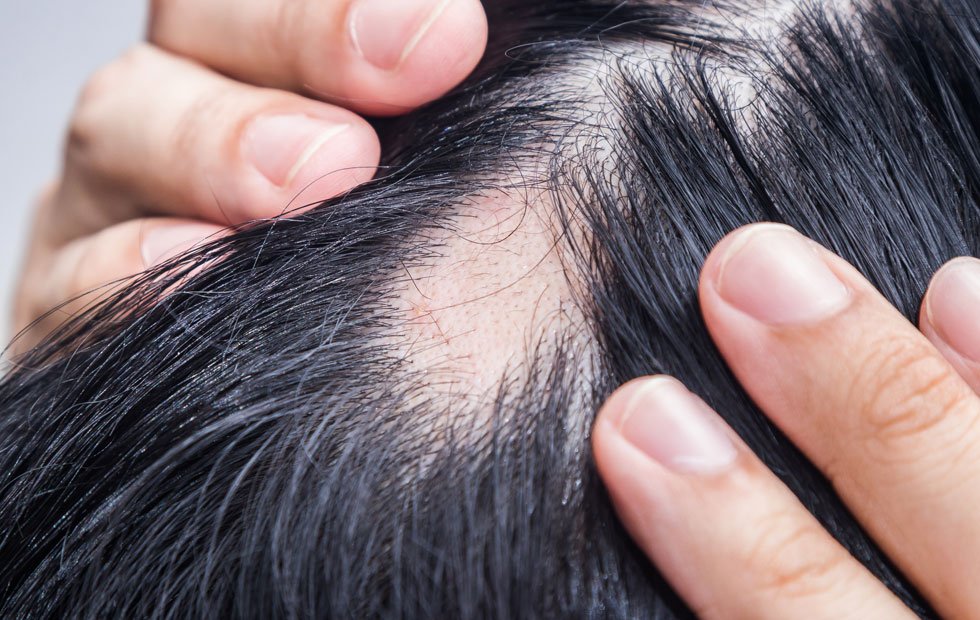 ภาวะผมร่วงเป็นหย่อม Alopecia Areata AA หลังฉีดวัคซีนโควิด-19 เกิดจากอะไรดูแลได้ อย่างไร?