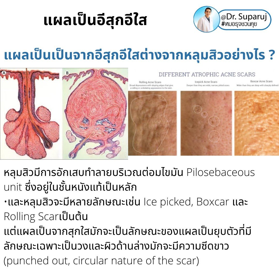 แผลเป็นยุบตัวจากอีสุกอีใส Chicken pox scars ดูแลได้อย่างไร ? แผลเป็นยุบตัวจากอีสุกอีใส Chicken pox scars ดูแลได้อย่างไร ?