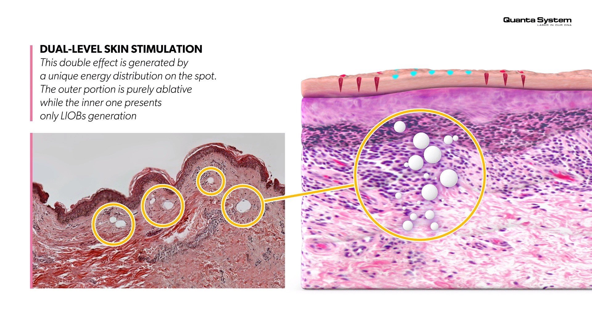 ทำความรู้จัก Discovery Pico Laser เทคนิค จุดเด่นในการดูแลรักษาปัญหาผิวหนัง หลุมสิว รูขุมขนกว้าง กระฝ้า จุดด่างดำ รอยสัก ทำความรู้จัก Discovery Pico Laser เทคนิค จุดเด่นในการดูแลรักษาปัญหาผิวหนัง หลุมสิว รูขุมขนกว้าง กระฝ้า จุดด่างดำ รอยสัก
