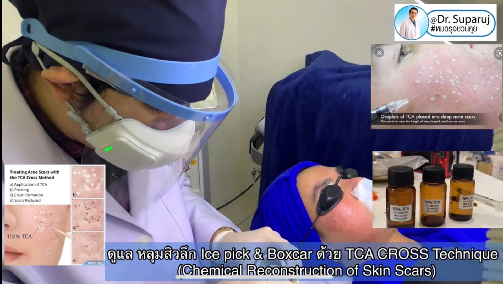 รักษาหลุมสิวด้วยการแต้มกรด TCA แล้วเกิดเป็นรอยดำ เกิดจากอะไรได้บ้าง? รักษาหลุมสิวด้วยการแต้มกรด TCA แล้วเกิดเป็นรอยดำ เกิดจากอะไรได้บ้าง?