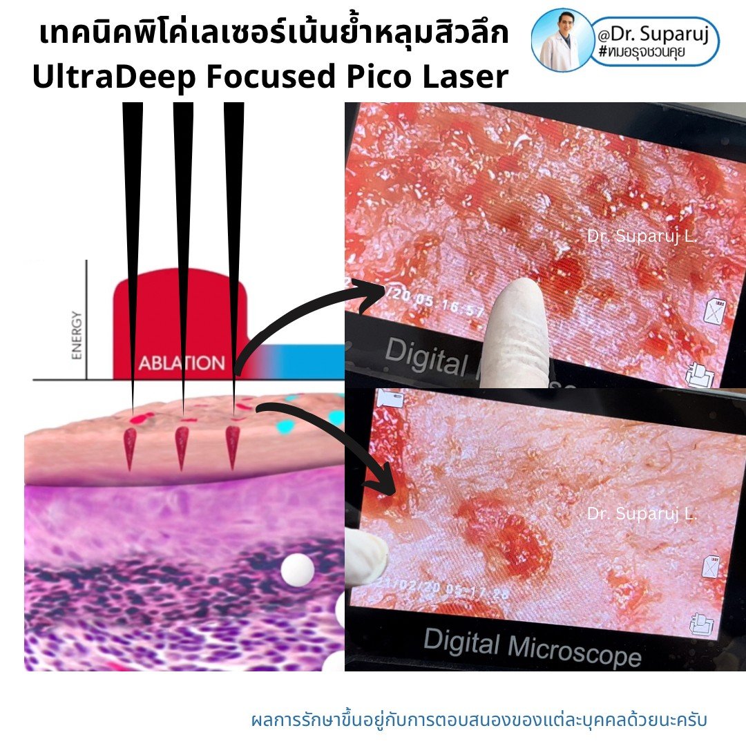 แนะนำเทคนิคดูแลหลุมสิว: เทคนิคพิโค่เลเซอร์เน้นย้ำหลุมสิวลึก UltraDeep Focused Picosecond Laser แนะนำเทคนิคดูแลหลุมสิว: เทคนิคพิโค่เลเซอร์เน้นย้ำหลุมสิวลึก UltraDeep Focused Picosecond Laser