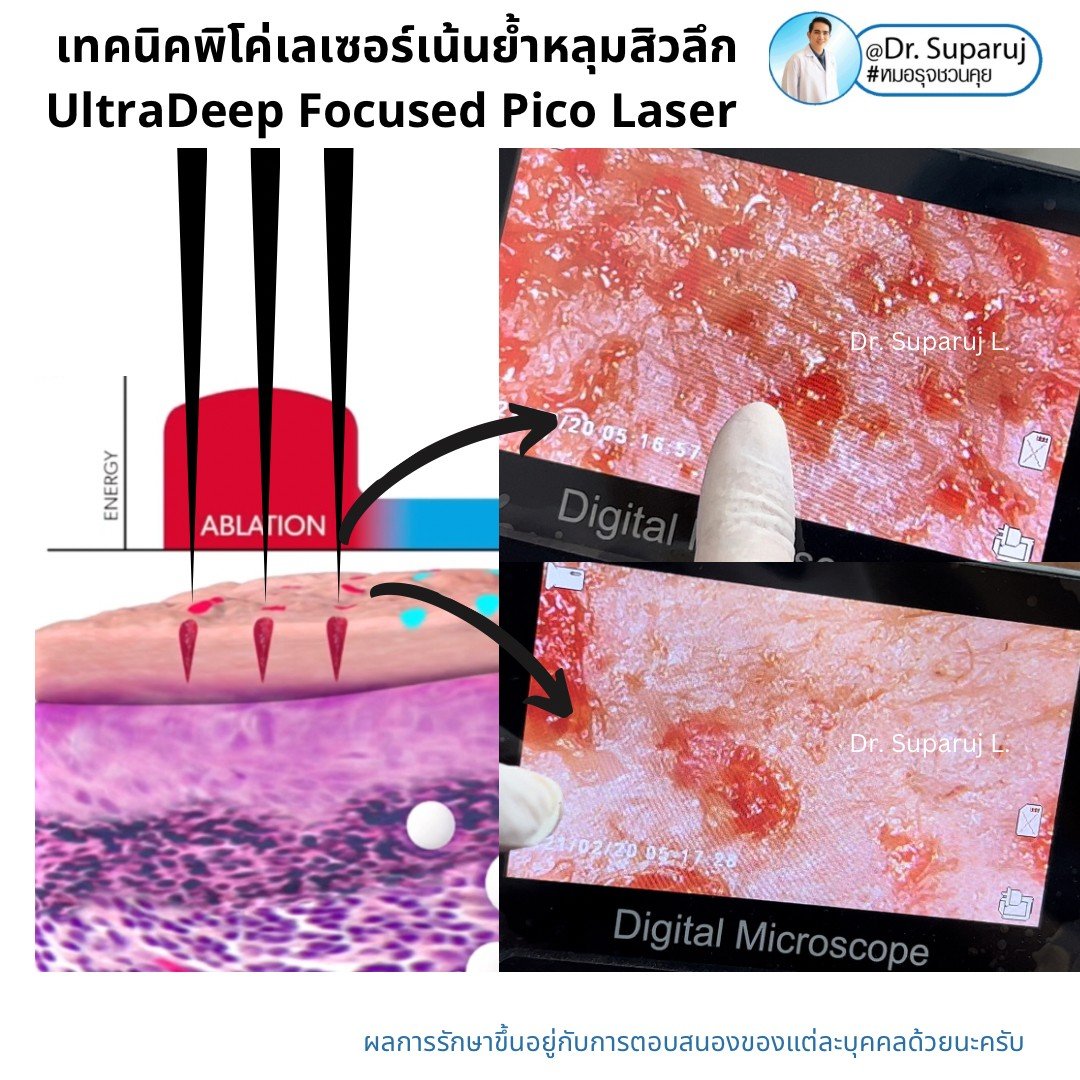 แนะนำเทคนิคดูแลหลุมสิว: เทคนิคพิโค่เลเซอร์เน้นย้ำหลุมสิวลึก UltraDeep Focused Picosecond Laser