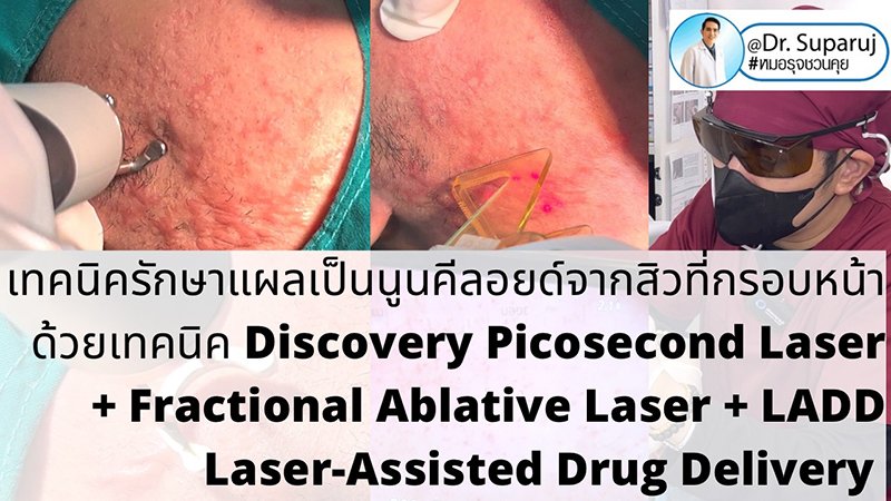  แนะนำเทคนิคดูแลแผลเป็นนูนคีลอยด์: รักษาแผลเป็นนูนคีลอยด์จากสิวที่กรอบหน้าด้วยเทคนิค Discovery Picosecond Laser + Fractional Ablative Laser + LADD Laser-Assisted Drug Delivery
