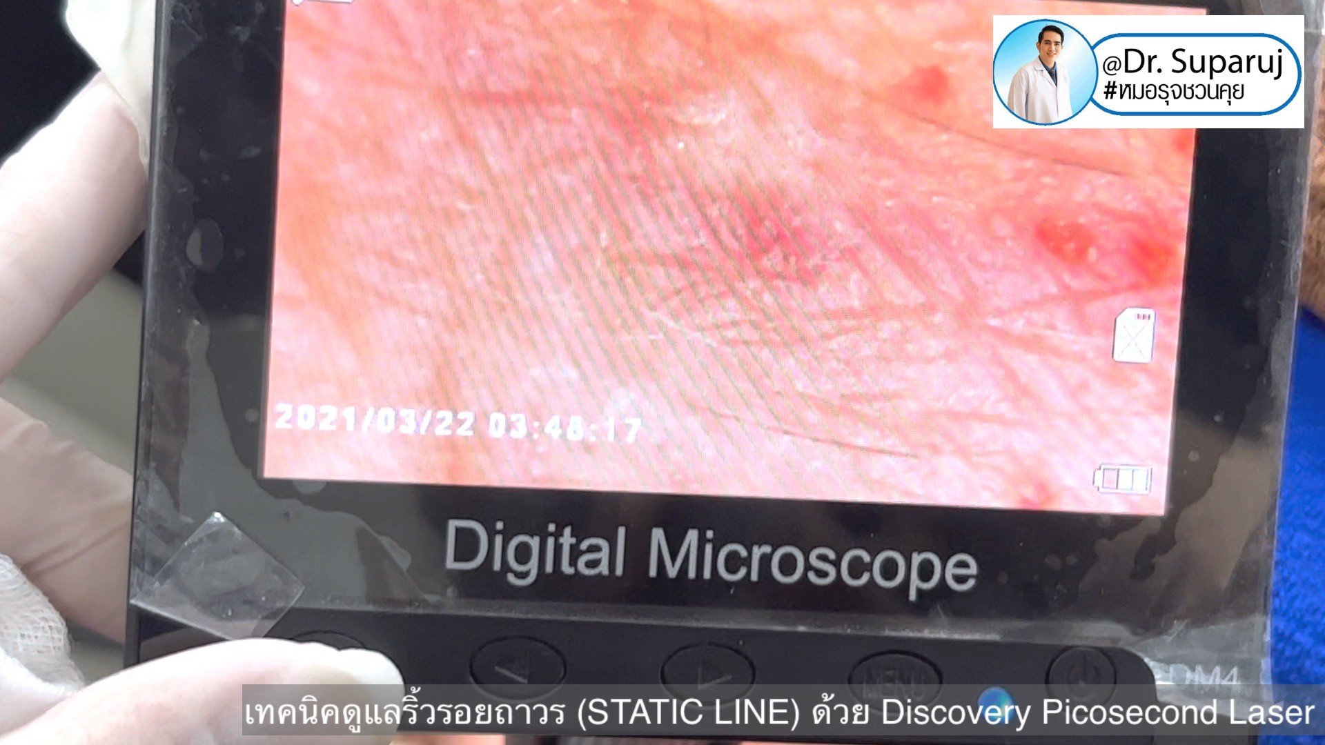 เทคนิคดูแลริ้วรอยถาวร (STATIC LINE) ด้วย Discovery Picosecond Laser เทคนิคดูแลริ้วรอยถาวร (STATIC LINE) ด้วย Discovery Picosecond Laser