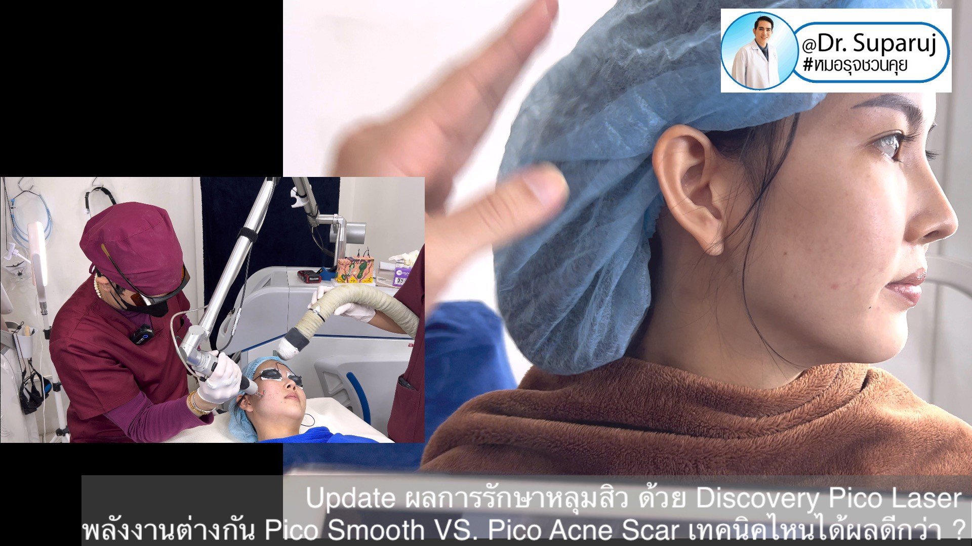 Update ผลการรักษาหลุมสิว ด้วย Discovery Pico Laser พลังงานต่างกัน Pico Smooth (Moderate Fluence) VS. Pico Acne Scar (High Fluence)เทคนิคไหนได้ผลดีกว่า ? Update ผลการรักษาหลุมสิว ด้วย Discovery Pico Laser พลังงานต่างกัน Pico Smooth (Moderate Fluence) VS. Pico Acne Scar (High Fluence)เทคนิคไหนได้ผลดีกว่า ?