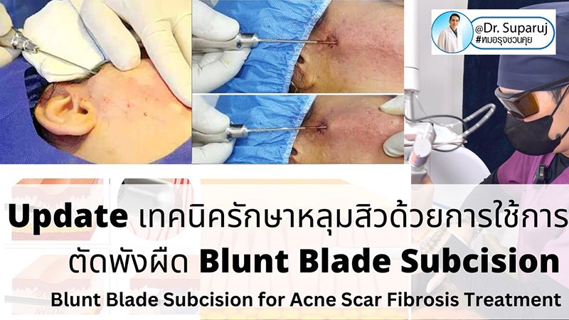 Update รักษาหลุมสิวด้วยเทคนิคการตัดพังผืด Blunt Blade Subcision (Blunt Blade Subcision for Acne Scar Fibrosis Treatment)