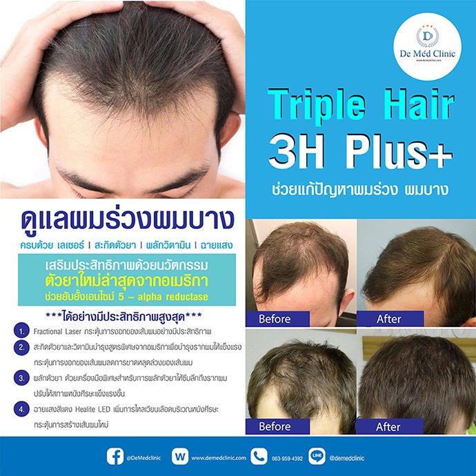Triple Hair 3H Plus ดูแลผมร่วงผมบาง ครบด้วย เลเซอร์ l สะกิดตัวยา | ผลักวิตามิน | ฉายแสง Triple Hair 3H Plus ดูแลผมร่วงผมบาง ครบด้วย เลเซอร์ l สะกิดตัวยา | ผลักวิตามิน | ฉายแสง