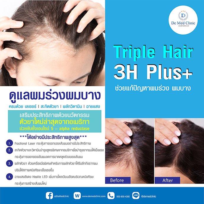 Triple Hair 3H Plus ดูแลผมร่วงผมบาง ครบด้วย เลเซอร์ l สะกิดตัวยา | ผลักวิตามิน | ฉายแสง Triple Hair 3H Plus ดูแลผมร่วงผมบาง ครบด้วย เลเซอร์ l สะกิดตัวยา | ผลักวิตามิน | ฉายแสง