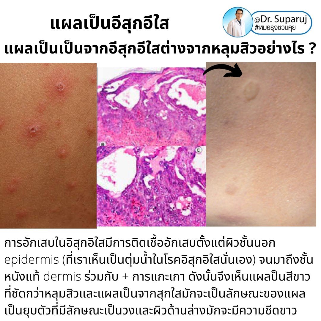 แผลเป็นยุบตัวจากอีสุกอีใส Chicken pox scars ดูแลได้อย่างไร ? แผลเป็นยุบตัวจากอีสุกอีใส Chicken pox scars ดูแลได้อย่างไร ?