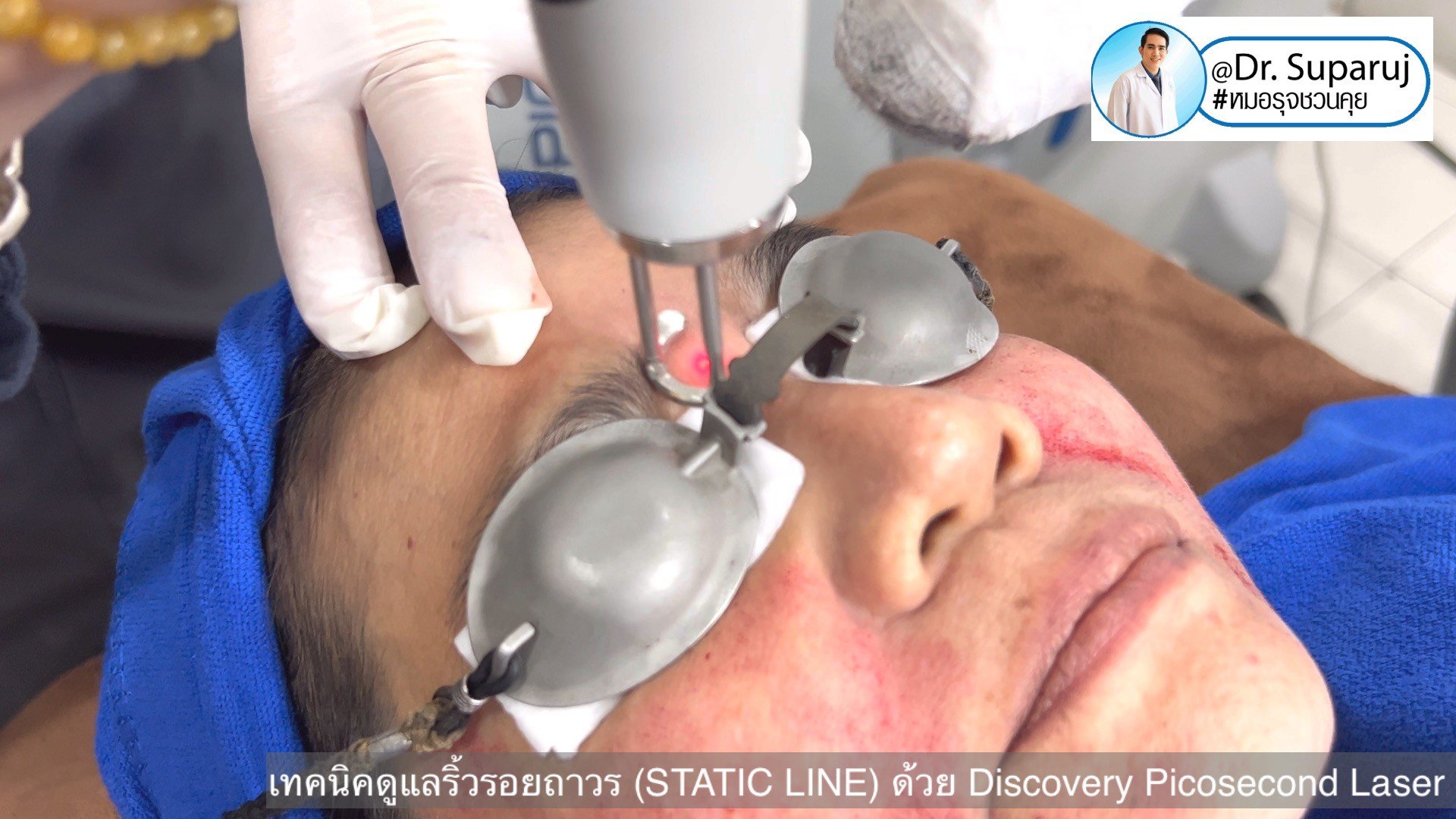เทคนิคดูแลริ้วรอยถาวร (STATIC LINE) ด้วย Discovery Picosecond Laser เทคนิคดูแลริ้วรอยถาวร (STATIC LINE) ด้วย Discovery Picosecond Laser