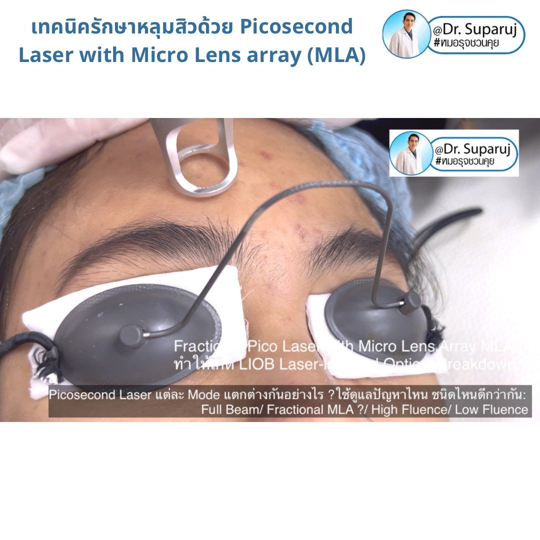 แนะนำเทคนิคดูแลหลุมสิว: Picosecond Laser แต่ละ Mode แตกต่างกันอย่างไร ? ใช้ดูแลปัญหาไหน ชนิดไหนดีกว่ากัน: Full Beam/ Fractional MLA ?/ High Fluence/ Low Fluence