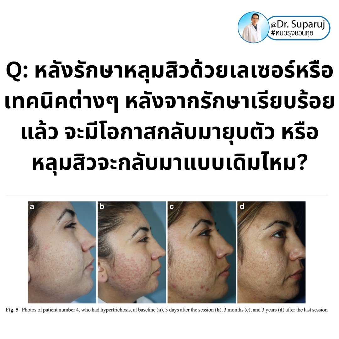 Q: หลังรักษาหลุมสิวด้วยเลเซอร์หรือเทคนิคต่างๆ หลังจากรักษาเรียบร้อยแล้ว จะมีโอกาสกลับมายุบตัว หรือหลุมสิวจะกลับมาแบบเดิมไหม? Q: หลังรักษาหลุมสิวด้วยเลเซอร์หรือเทคนิคต่างๆ หลังจากรักษาเรียบร้อยแล้ว จะมีโอกาสกลับมายุบตัว หรือหลุมสิวจะกลับมาแบบเดิมไหม?